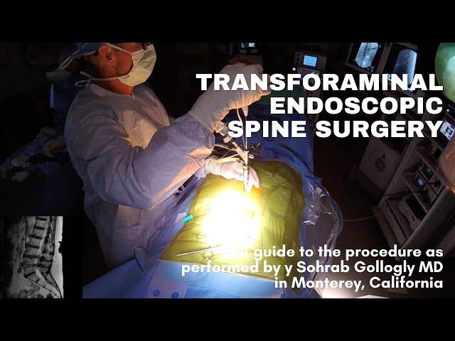 My technique for transforaminal endoscopic spine surgery