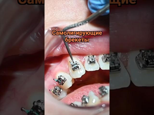 Самолигирующие металлические брекеты #брекеты #исправлениеприкуса #самара