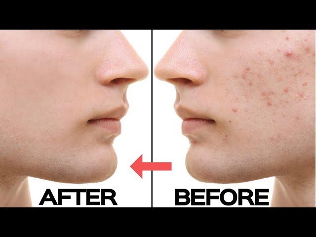 FACE PACK DARK SARKEL  WHITENING  PAPAL CONTROL AT HOME |QADRI SALON| YOUTUBE 2020