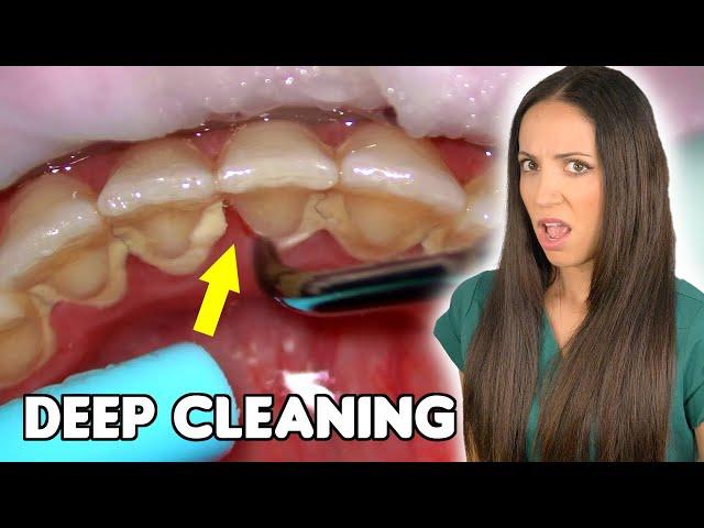 Deep Cleaning With HEAVY Tartar Build Up At The Dentist