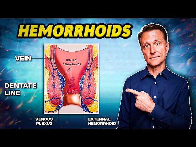 The #1 Best Remedy for Hemorrhoids - Dr. Berg