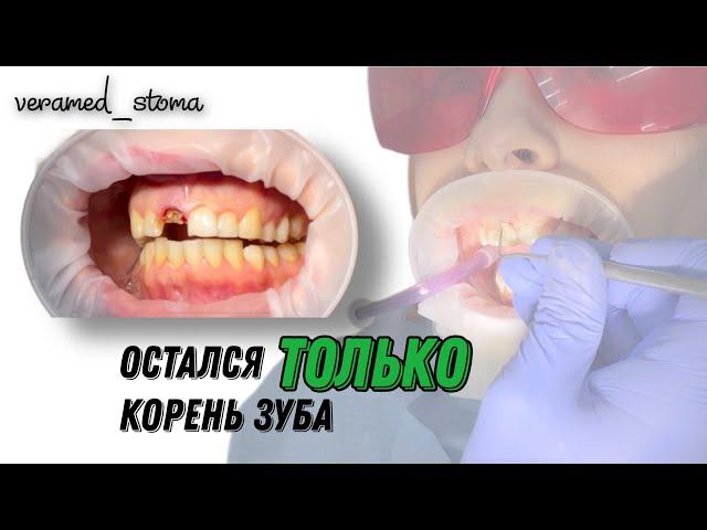 Наращивание зуба Остался только корень