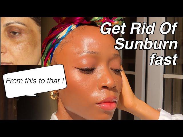 Get Rid of Sunburn Fast | Natural At home remedy