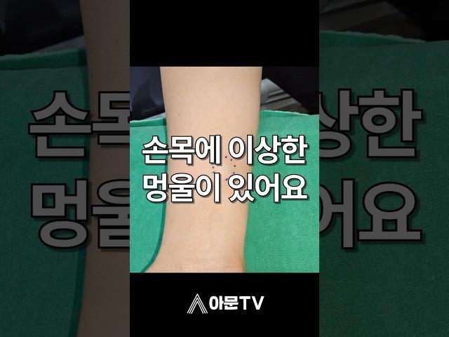 손목에 있는 이상한 멍울의 정체는?!(성형외과 손목 멍울 낭종 표피낭종 피지낭종 나선선종 수술 출혈 압출 후기)[아문TV]