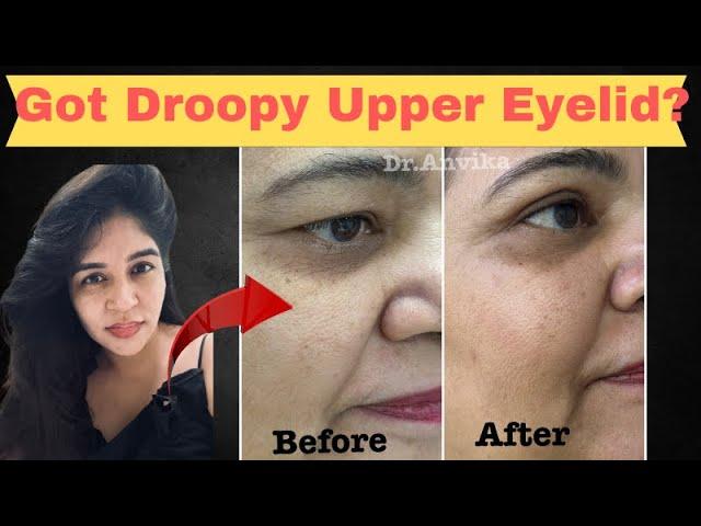 Get young with upper Eye lid Surgery. // dr. anvika // 9999 747 717