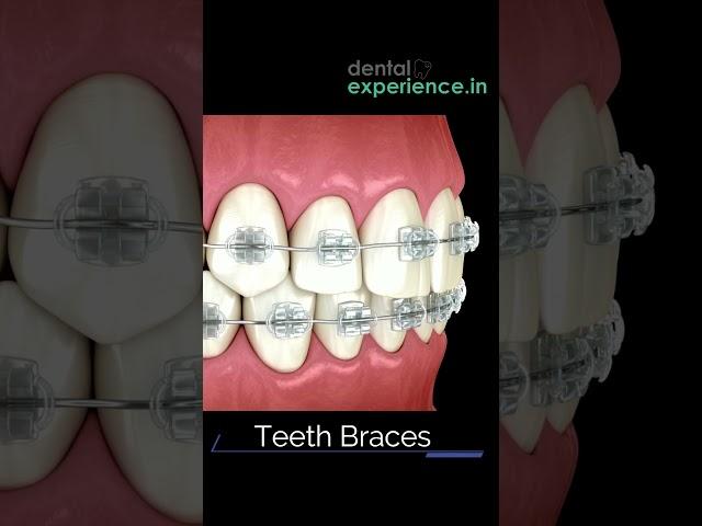 Affordable | Metal braces | Ceramic Teeth Braces | Clear Teeth Aligners Cost in Kochi, Kerala, India