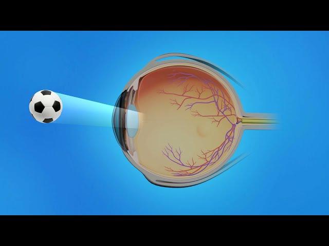 Age-Related Macular Degeneration (AMD): Types, Causes, Symptoms, Treatment