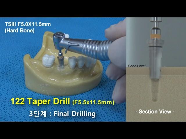 Osstem - 122 Taper KIT User Guide