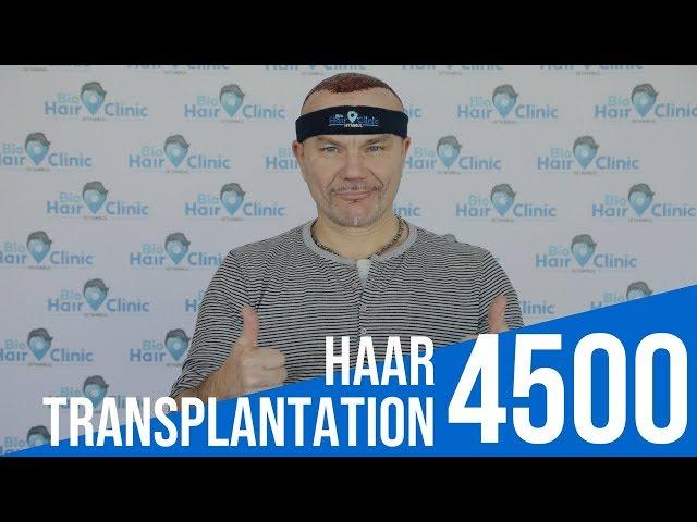 Haartransplantation Istanbul  - Erfahrung Türkei 4500 Grafts