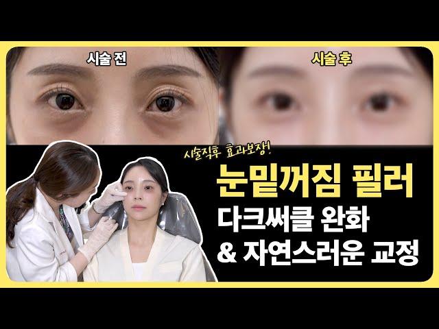 Are you worried about sunken eyes and dark circles?Natural under-eye filler⏩️Procedure, design...