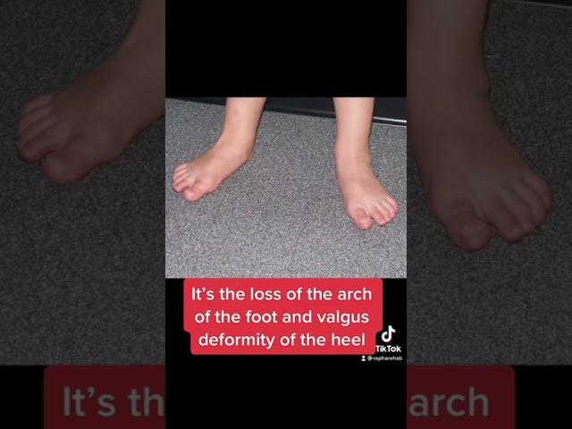 Pes planus or “flat feet”