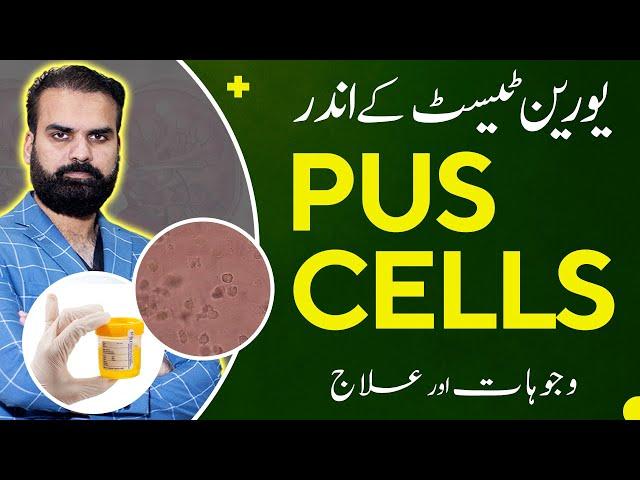 Pus in Urine | High Pus Cells in Urine Test Causes Symptoms & Treatment