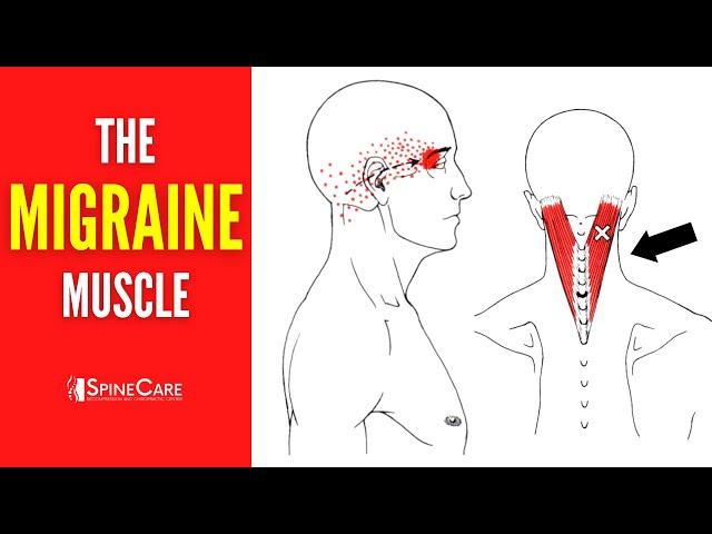 How to Release Tension for FAST MIGRAINE RELIEF