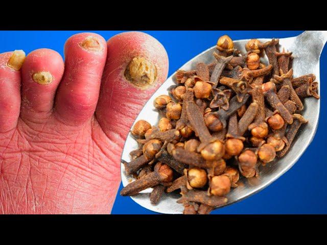 Cure Toenail Fungus For Less Than $0.5 / Have Toenail Fungus? You have to do it