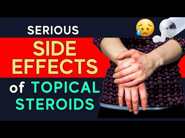 Topical Steroid Skin Side Effects Are REAL (What You Need To Know) | Dr. Luis Franco