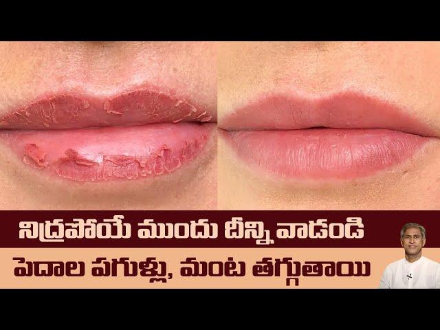 Home Remedy for Dry Lips | Reduces Cracked Lips | Get Beautiful Lips | Dr. Manthena's Health Tips