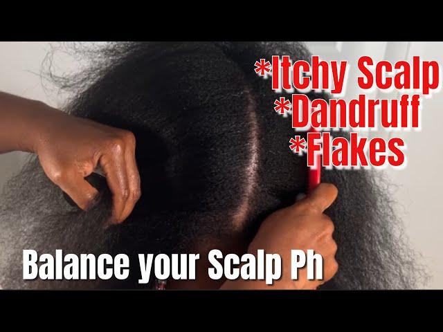 Get Rid of Dandruff and Flakes  Balance your Scalp Ph