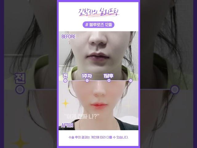 #shorts  강남12 실리프팅 블루로즈 12줄 이중턱 투턱 팔자주름 필러 눈가주름 심부볼 볼살처짐