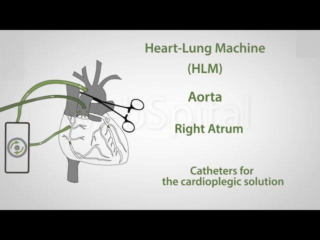 Coronary artery bypass surgery with the heart lung mashine