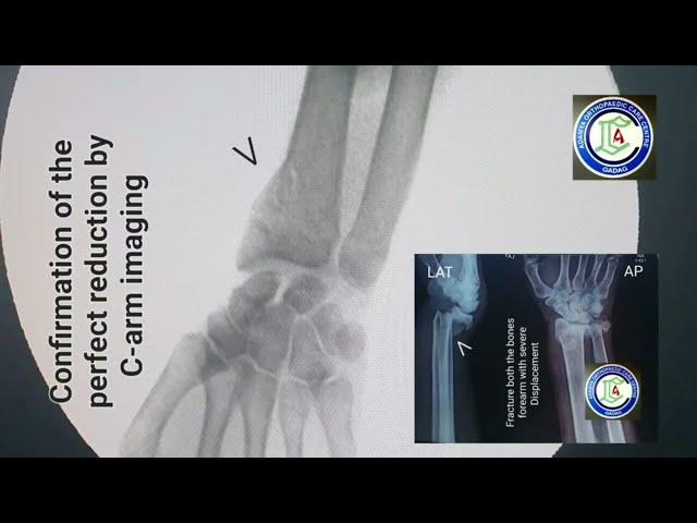 Communited fracture Lower end Radius | Wrist / forearm injuries | Closed reduction | K-wire | Adamya