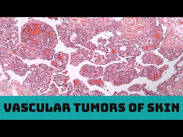 Vascular Tumors of Skin (31 cases in 3 hours): Board Review for Pathology Dermatology Dermpath