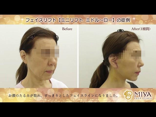 【スッキリ！顔のたるみ取り】フェイスリフト(ミニリフト　ミドル～ロー)の症例 ／MIYAフェイスクリニック