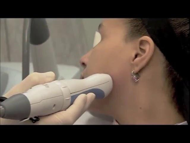 Scar Treatment with Palomar Fractional Laser