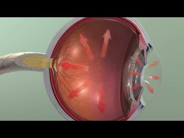 Animation: Glaucoma