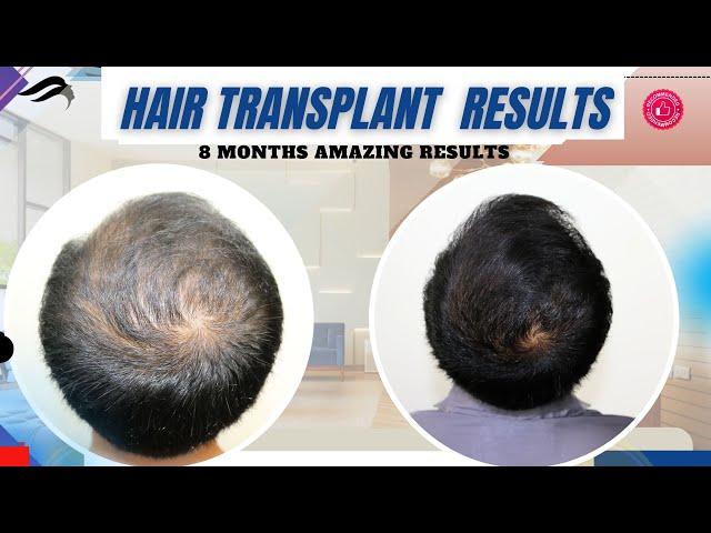 Hair Transplant In Hubli | Best Center Results Surgeon & Cost Of Hair Transplant In Hubli