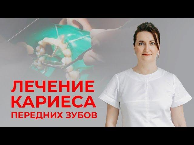 Кариес передних зубов l Процесс реставрации от лица стоматолога