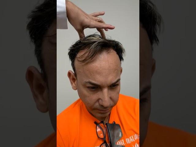 Transplante de cabello - paso a paso | Care4Hair