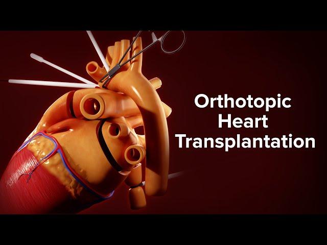 Medical Animation: Orthotopic Heart Transplantation | Cincinnati Children's