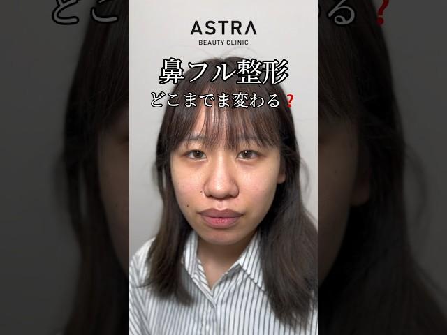 鼻フルしたらどれくらい変わる#アストラビューティークリニック #astrabeautyclinic #塩満先生 #塩満恵子 #忘れ鼻 #鼻整形 #鼻整形ダウンタイム #垢抜け #美容外科 渋谷