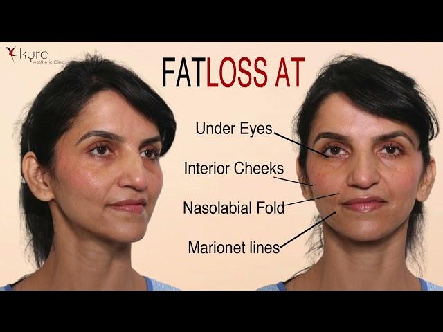 Fat Transfer to Face in Ludhiana, Punjab | Facial Transformation