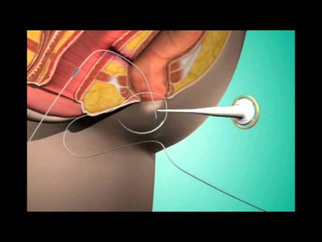 Fistula Treatment in Pune | Fistula Hospital in Pune | Dr. Ashwin Porwal - Fistula Surgeon Pune