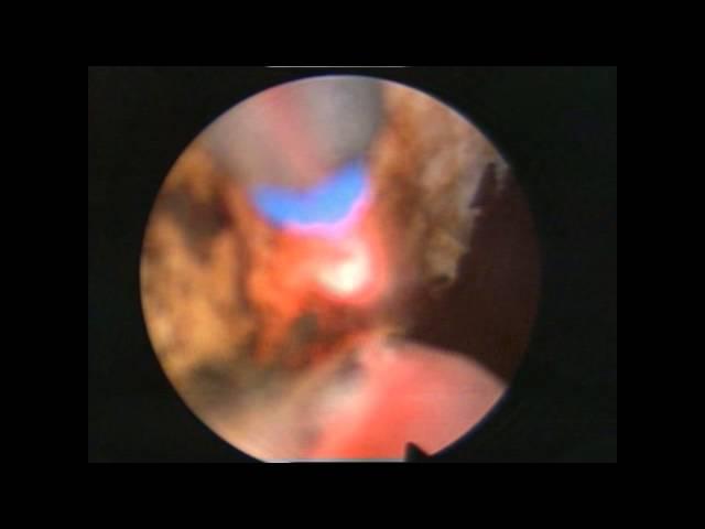 Simultaneous Thulep and hernioplasty. Dr. Farid Gadimaliyev, Customs Hospital, Baku, Azerbaijan