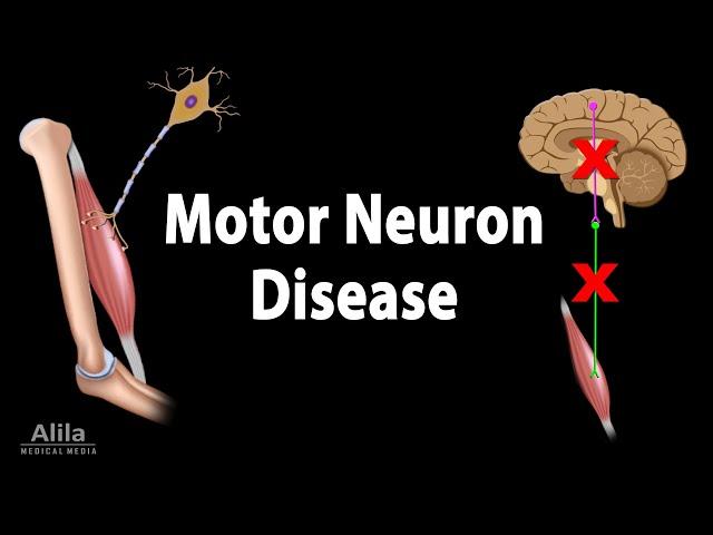 Motor Neuron Disease, Animation