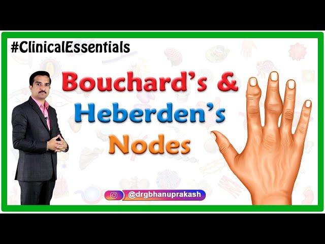 Bouchard’s and Heberden’s nodes : Clinical essentials : Dr G Bhanu Prakash