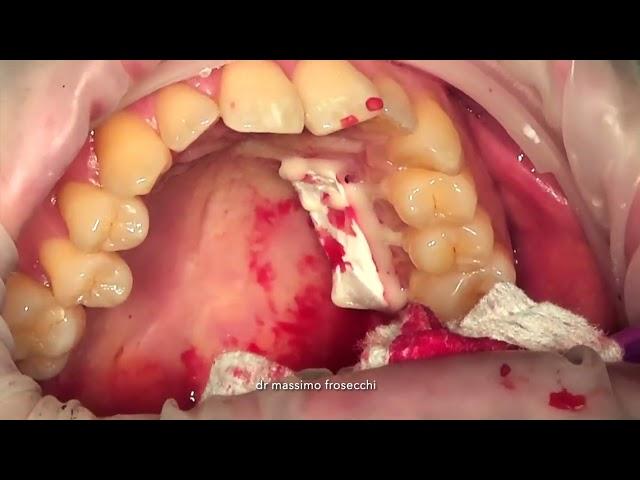 connective tissue with donor site protection