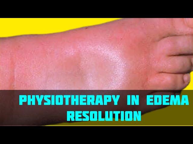 Physiotherapy management of swollen feet|Physiotherapy in edema resolution |