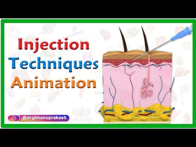 Injection Techniques Animation : Intradermal, Intramuscular, Subcutaneous and Z track