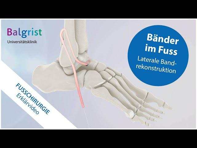 Laterale Bandrekonstruktion am Fuss