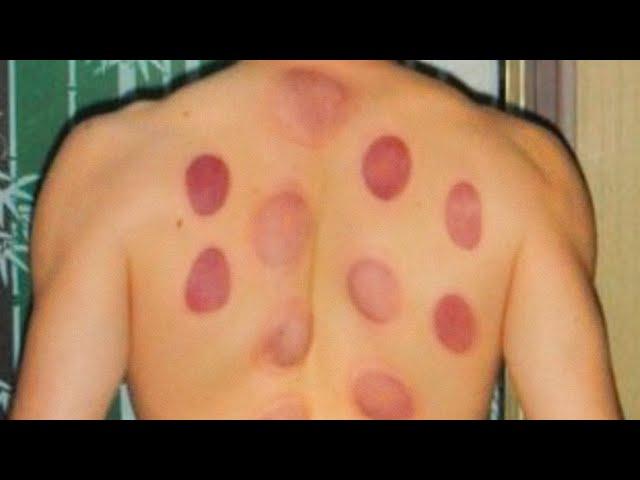 What You Need to Know About Cupping