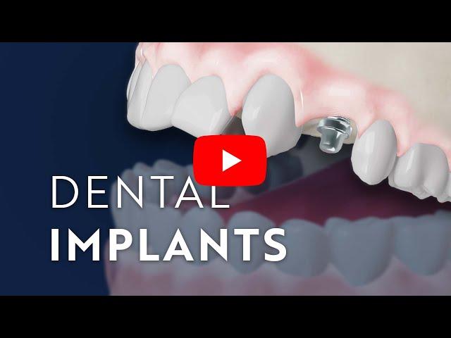 Dental Implants: Restore Function and Preserve Health