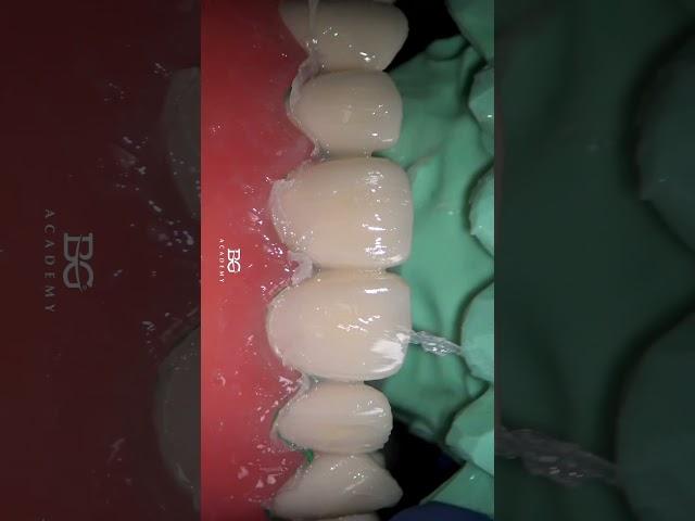 Temporary veneers - demo time. #temporaryrestorations #veneers #dentalhacks