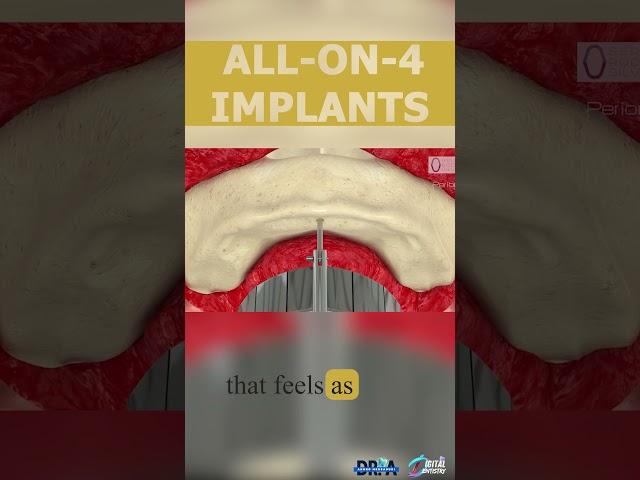 All-on-4 Implants: A New Smile in Just One Day!