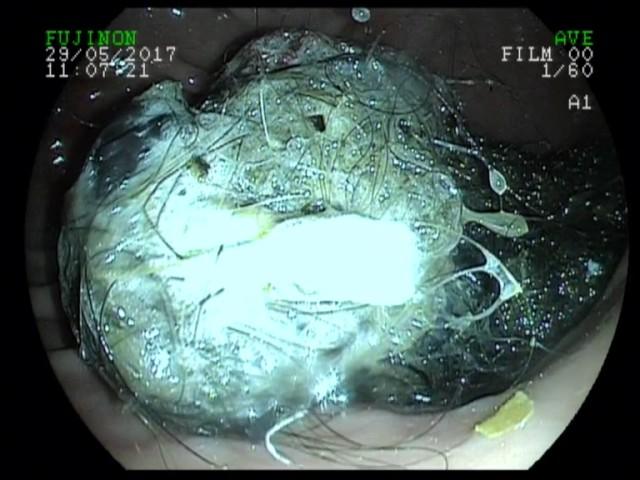 Foreign body + lymphoplasmacytic gastritis