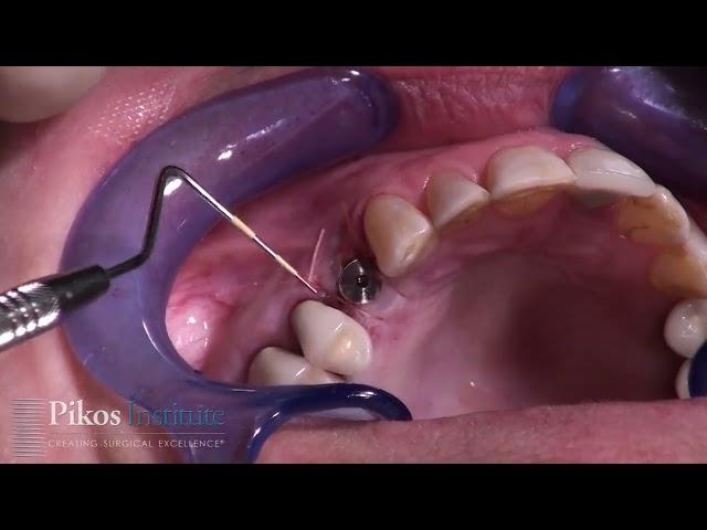 Single Implant Placement Maxillary First Bicuspid - Implant Course