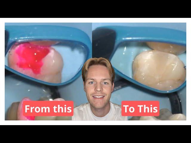 Replacing an Old Composite Filling: Step-by-Step Dental Restoration Explained!