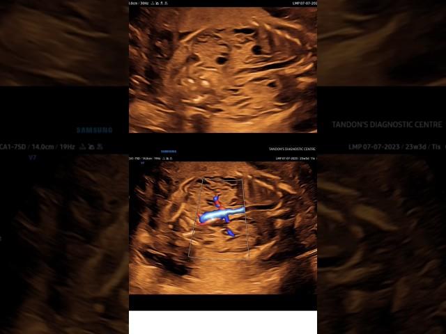Multicystic dysplastic kidney (MCDK) #fetalultrasound #pregnancy #kidney #anomaly #shorts